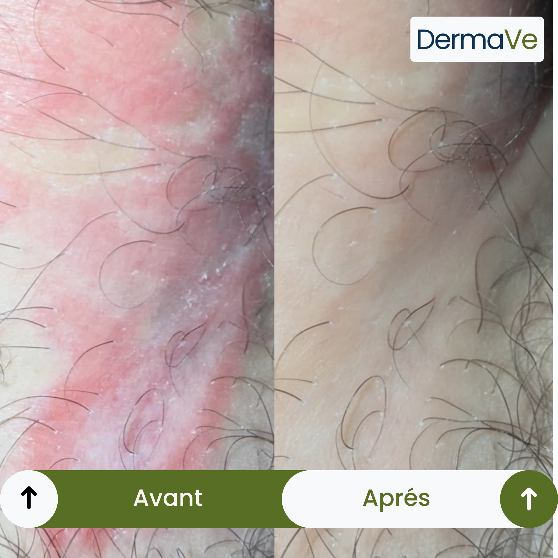 DermaVe® Savon Anti-Mycoses